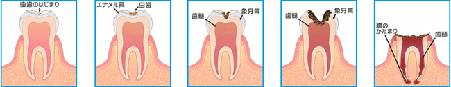 虫歯の進行イメージ